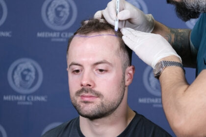 greffe de cheveux